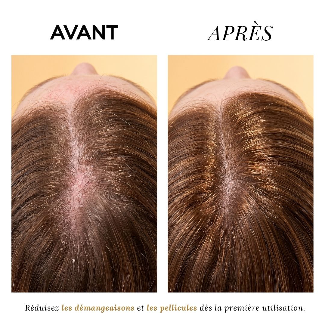 Routine pour cuir chevelu sensible / irritations / pellicules